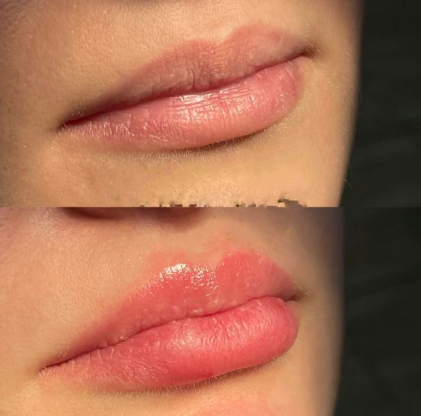 preenchimento labial